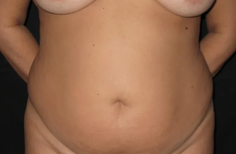Abdominoplastia, Caso 1 · frente, antes