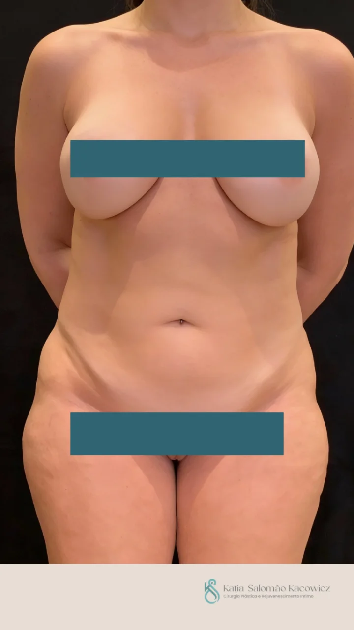 Lipoaspiração, Caso 1, antes