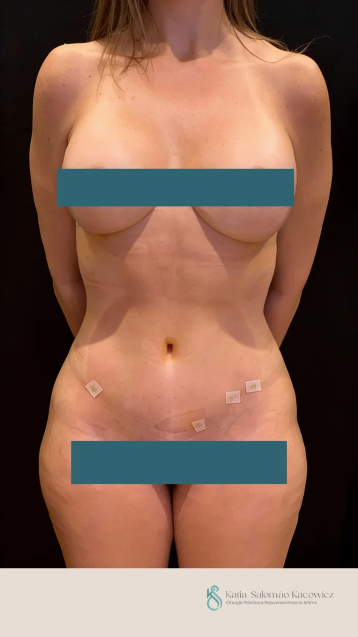 Lipoaspiração, Caso 1, depois